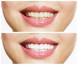 Clearwater FL Cosmetic Dentist Offers Teeth Whitening