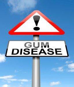 Gum Disease Symptoms | Andrew Holloman, DDS, Clearwater FL