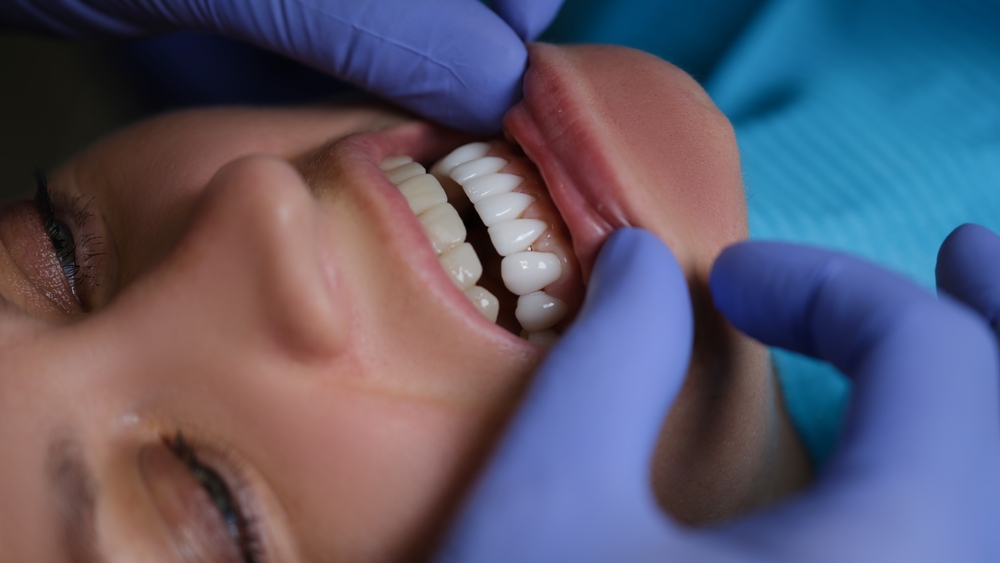 Clearwater Fl Dental Veneers