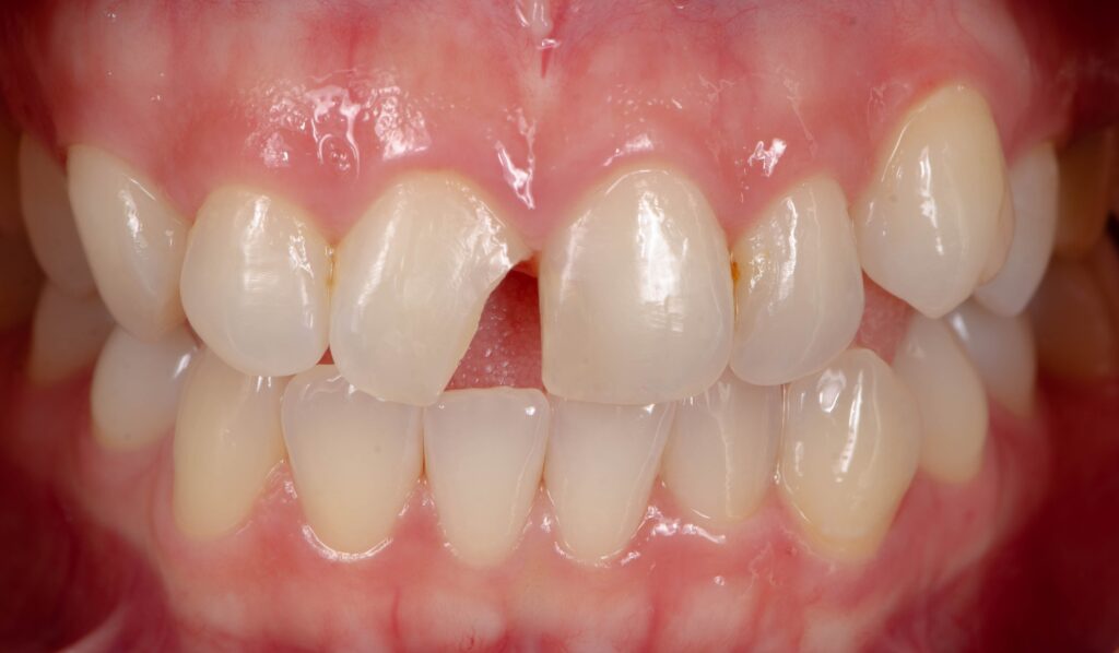 Chipped Tooth: What to Do Right Away