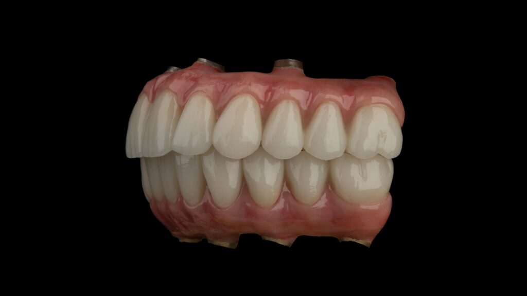 The Pros and Cons of All on 4 Dental Implants