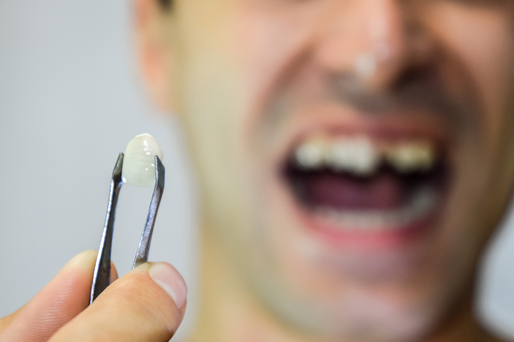 What Happens If My Veneer Falls Off? Emergency Steps & Solutions