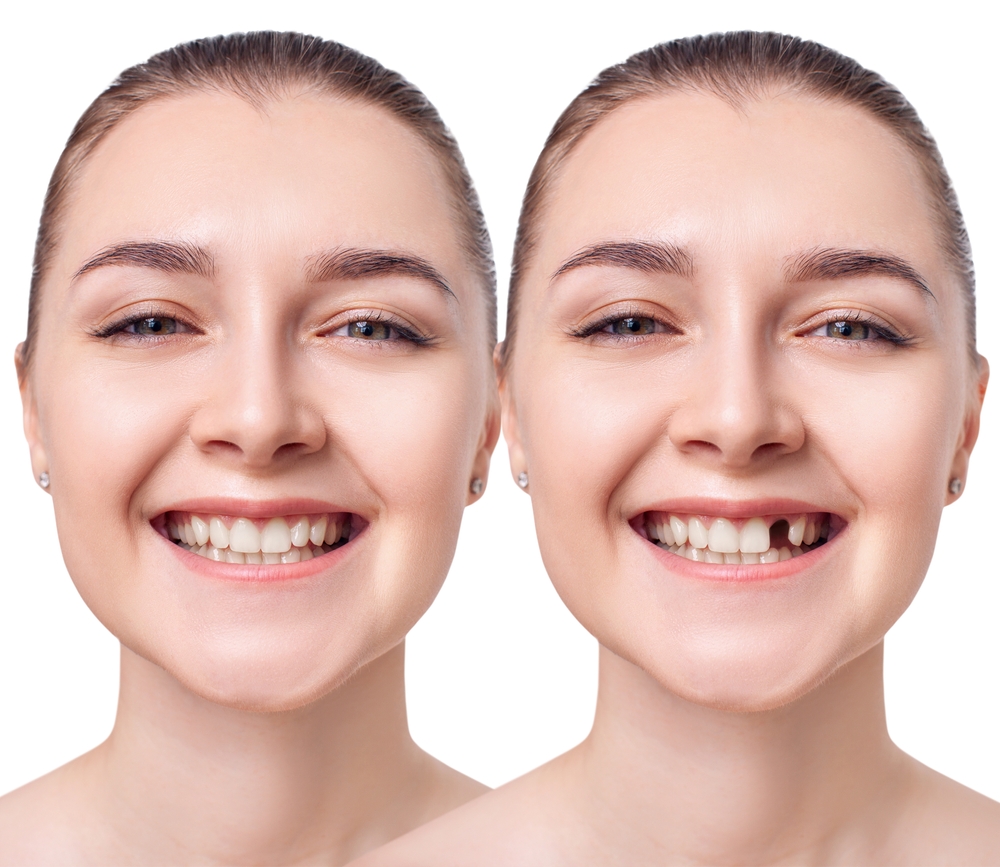 Before & After Dental Veneers: What to Expect From Your Smile Transformation