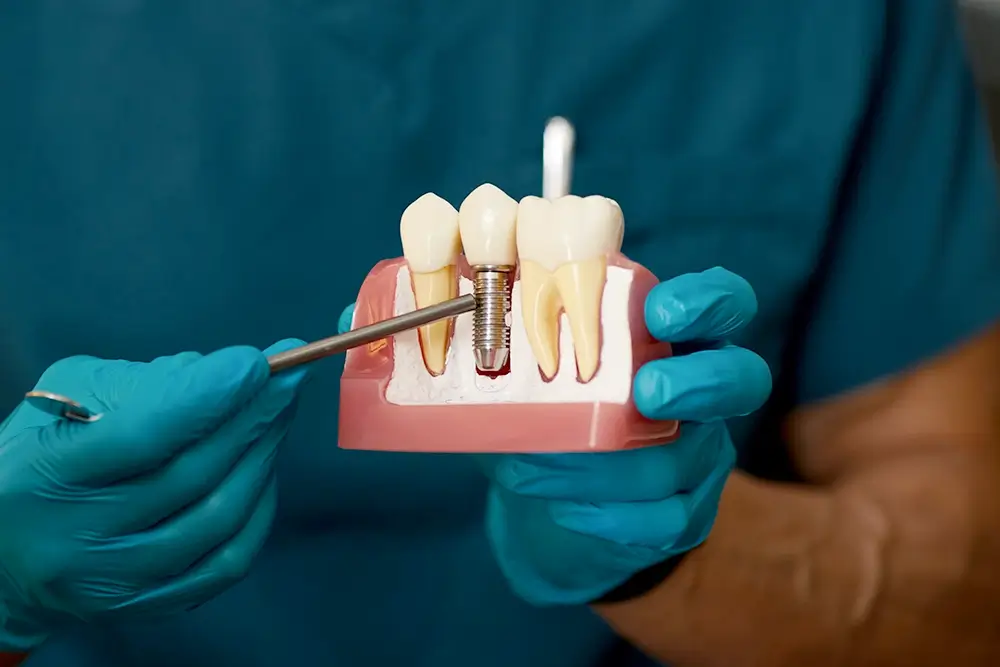 Understanding the Dental Implant Procedure Steps