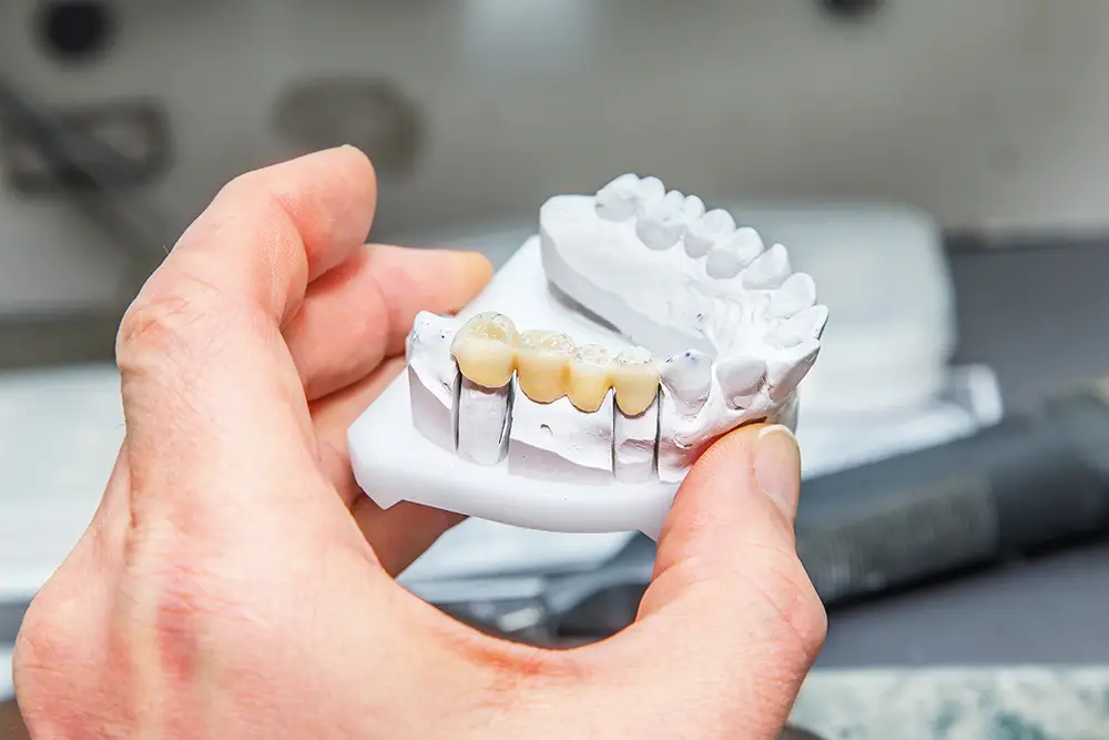 Missing a tooth and weighing your options? Learn how adhesive bridges and traditional bridges differ in prep, cost, and longevity to find the best fit for your smile.